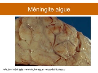 Méningite aigue Infection méningée > méningite aigue > exsudat fibrineux 