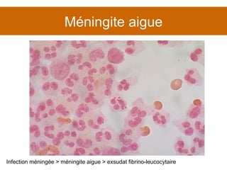 Méningite aigue Infection méningée > méningite aigue > exsudat fibrino-leucocytaire 