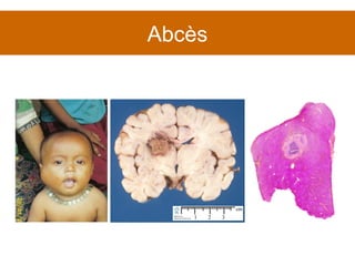 Abcès 