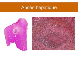 Abcès hépatique 