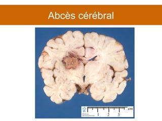 Abcès cérébral 