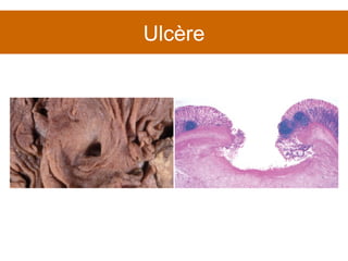 Ulcère 