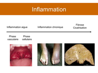 Inflammation Inflammation aigue Inflammation chronique Fibrose Cicatrisation Phase  vasculaire Phase  cellulaire 