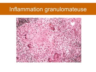 Inflammation granulomateuse 
