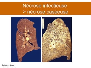 Nécrose infectieuse  > nécrose caséeuse Tuberculose 