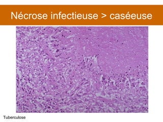 Nécrose infectieuse > caséeuse Tuberculose 