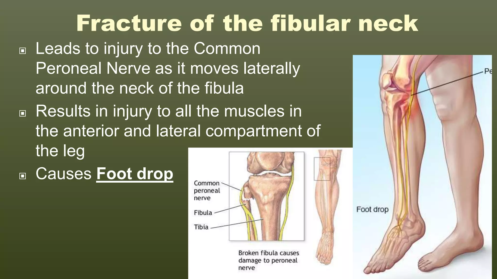 Leg Small Injury 5 Injuries of the Lower Limb.pptx