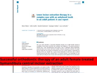 Successful orthodontic therapy of an adult female treated
bymandibula central incisor extraction
 