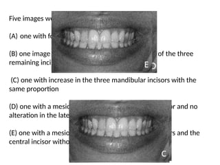Five images were obtained:
(A) one with four incisors
(B) one image without any alteration to the width of the three
remaining incisors
(C) one with increase in the three mandibular incisors with the
same proportion
(D) one with a mesiodistal increase in the central incisor and no
alteration in the lateral incisors, and
(E) one with a mesiodistal increase in the lateral incisors and the
central incisor without any alteration
 