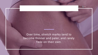 The Power of Micro-Needling as Stretch Marks Removal Treatment