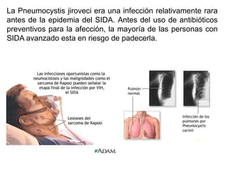 La Pneumocystis jiroveci era una infección relativamente rara
antes de la epidemia del SIDA. Antes del uso de antibióticos
preventivos para la afección, la mayoría de las personas con
SIDA avanzado esta en riesgo de padecerla.
 