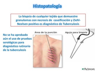 Histopatología

           La biopsia de cualquier tejido que demuestre
         granulomas con necrosis de caseificación y Ziehl-
          Neelsen positiva es diagnóstico de Tuberculosis


No se ha aprobado
aún el uso de pruebas
serológicas para
diagnóstico rutinario
de la tuberculosis
 