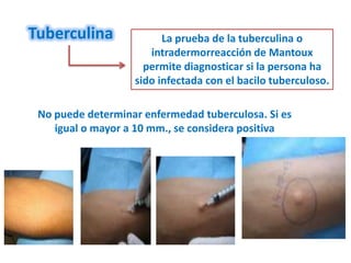 Tuberculina              La prueba de la tuberculina o
                      intradermorreacción de Mantoux
                     permite diagnosticar si la persona ha
                   sido infectada con el bacilo tuberculoso.

 No puede determinar enfermedad tuberculosa. Si es
    igual o mayor a 10 mm., se considera positiva
 
