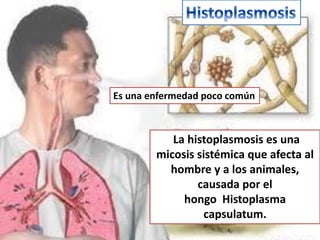 Es una enfermedad poco común



           La histoplasmosis es una
        micosis sistémica que afecta al
          hombre y a los animales,
                causada por el
             hongo Histoplasma
                 capsulatum.
 
