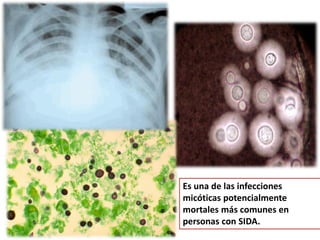 Es una de las infecciones
micóticas potencialmente
mortales más comunes en
personas con SIDA.
 