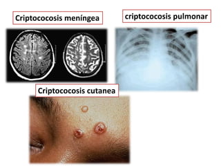 Criptococosis meníngea       criptococosis pulmonar




     Criptococosis cutanea
 