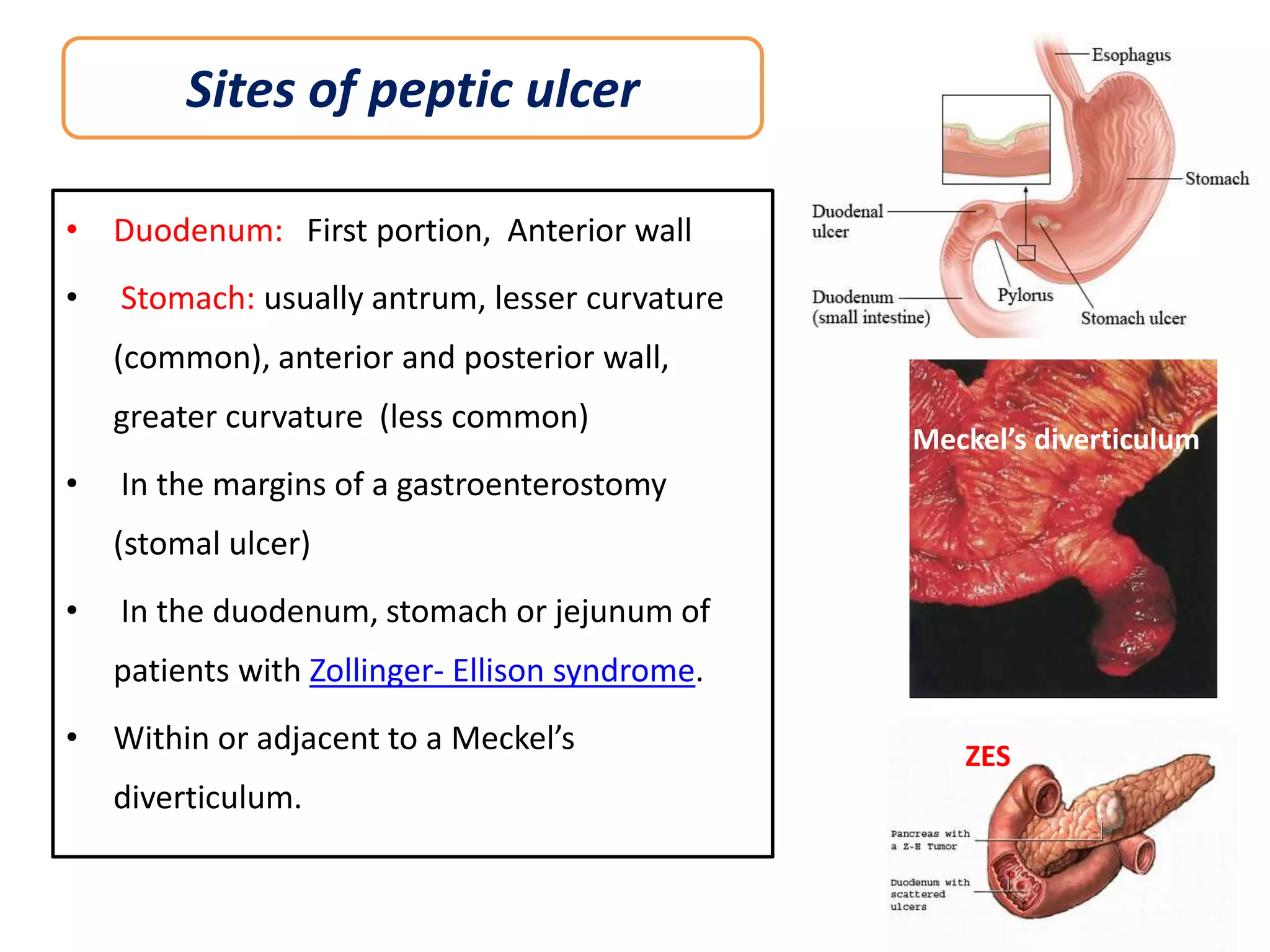 Sites of peptic ulcer
• Duodenum: First portion, Anterior wall
•

Stomach: usually antrum, lesser curvature
(common), anterior and posterior wall,
greater curvature (less common)

•

Meckel’s diverticulum

In the margins of a gastroenterostomy

(stomal ulcer)
•

In the duodenum, stomach or jejunum of
patients with Zollinger- Ellison syndrome.

• Within or adjacent to a Meckel’s
diverticulum.

ZES

 