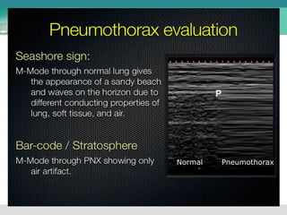 Normal Pneumothorax
 