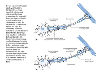 Bloque (A) desmielinización
aguda y conducción.
Conducción es eficaz
cuando la mielina está
intacta, con la rápida
propagación del potencial
de acción. Cuando el axón
esta desmielinizada, la
corriente es incapaz de
despolarizar la membrana
debido a la fuga de
corriente y un menor
número de canales de sodio
dependientes de voltaje.
Esto resulta en un fracaso
de la conducción. (B)
desmielinización crónica y
conducción desaceleración.
Un aumento compensatorio
de los canales de sodio
dependientes de voltaje a lo
largo de la porción
desmielinizada del axón
permite la propagación del
potencial de acción, pero
esto será más lenta que la
conducción relativa a la
danza
 