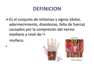 DEFINICION
Es el conjunto de síntomas y signos (dolor,
adormecimiento, disestesias, falta de fuerza)
causados por la compresión del nervio
mediano a nivel de la
muñeca.
•
 