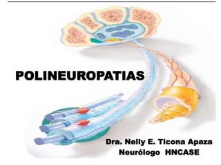 Dra. Nelly E. Ticona Apaza
Neurólogo HNCASE
POLINEUROPATIAS
 