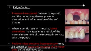 5)pontic and pontic designs [Autosaved].pptx
