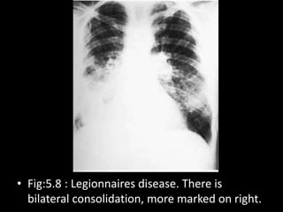 • Fig:5.8 : Legionnaires disease. There is
bilateral consolidation, more marked on right.
 