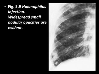 • Fig. 5.9 Haemophilus
infection.
Widespread small
nodular opacities are
evident.
 