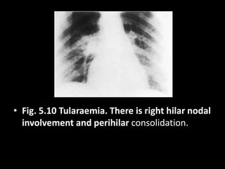 • Fig. 5.10 Tularaemia. There is right hilar nodal
involvement and perihilar consolidation.
 