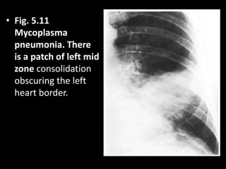 • Fig. 5.11
Mycoplasma
pneumonia. There
is a patch of left mid
zone consolidation
obscuring the left
heart border.
 