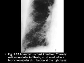 • Fig. 5.12 Adenovirus chest infection. There is
reticulonodular infiltrate, most marked in a
bronchovascular distribution at the right base.
 