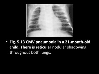 • Fig. 5.13 CMV pneumonia in a 21-month-old
child. There is reticular nodular shadowing
throughout both lungs.
 