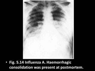 • Fig. 5.14 Influenza A. Haemorrhagic
consolidation was present at postmortem.
 