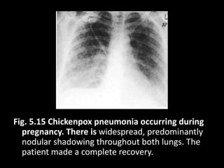 Fig. 5.15 Chickenpox pneumonia occurring during
pregnancy. There is widespread, predominantly
nodular shadowing throughout both lungs. The
patient made a complete recovery.
 