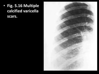 • Fig. 5.16 Multiple
calcified varicella
scars.
 