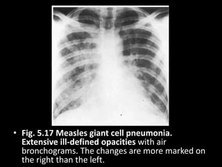 • Fig. 5.17 Measles giant cell pneumonia.
Extensive ill-defined opacities with air
bronchograms. The changes are more marked on
the right than the left.
 