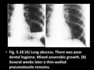 • Fig. 5.18 (A) Lung abscess. There was poor
dental hygiene. Mixed anaerobic growth. (B)
Several weeks later a thin-walled
pneumatocele remains.
 