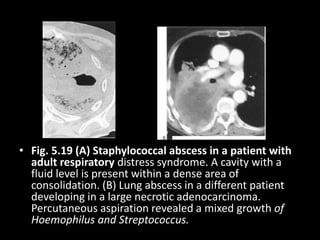• Fig. 5.19 (A) Staphylococcal abscess in a patient with
adult respiratory distress syndrome. A cavity with a
fluid level is present within a dense area of
consolidation. (B) Lung abscess in a different patient
developing in a large necrotic adenocarcinoma.
Percutaneous aspiration revealed a mixed growth of
Hoemophilus and Streptococcus.
 