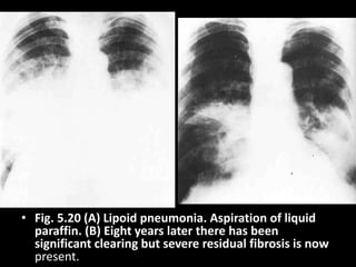 • Fig. 5.20 (A) Lipoid pneumonia. Aspiration of liquid
paraffin. (B) Eight years later there has been
significant clearing but severe residual fibrosis is now
present.
 