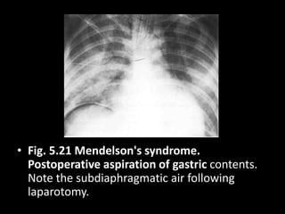 • Fig. 5.21 Mendelson's syndrome.
Postoperative aspiration of gastric contents.
Note the subdiaphragmatic air following
laparotomy.
 