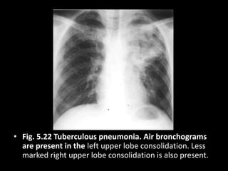• Fig. 5.22 Tuberculous pneumonia. Air bronchograms
are present in the left upper lobe consolidation. Less
marked right upper lobe consolidation is also present.
 