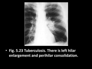 • Fig. 5.23 Tuberculosis. There is left hilar
enlargement and perihilar consolidation.
 