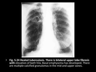 • Fig. 5.24 Healed tuberculosis. There is bilateral upper lobe fibrosis
with elevation of both hila. Basal emphysema has developed. There
are multiple calcified granulomas in the mid and upper zones.
 