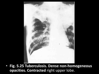 • Fig. 5.25 Tuberculosis. Dense non-homogeneous
opacities. Contracted right upper lobe.
 