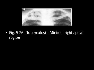 • Fig. 5.26 : Tuberculosis. Minimal right apical
region
 
