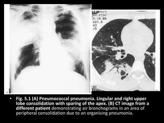 • Fig. 5.1 (A) Pneumococcal pneumonia. Lingular and right upper
lobe consolidation with sparing of the apex. (B) CT image from a
different patient demonstrating air bronchograms in an area of
peripheral consolidation due to an organising pneumonia.
 