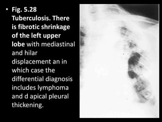 • Fig. 5.28
Tuberculosis. There
is fibrotic shrinkage
of the left upper
lobe with mediastinal
and hilar
displacement an in
which case the
differential diagnosis
includes lymphoma
and d apical pleural
thickening.
 