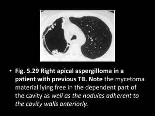 • Fig. 5.29 Right apical aspergilloma in a
patient with previous TB. Note the mycetoma
material lying free in the dependent part of
the cavity as well as the nodules adherent to
the cavity walls anteriorly.
 