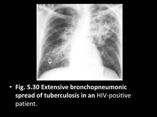 • Fig. 5.30 Extensive bronchopneumonic
spread of tuberculosis in an HIV-positive
patient.
 