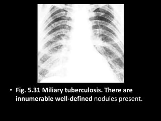 • Fig. 5.31 Miliary tuberculosis. There are
innumerable well-defined nodules present.
 